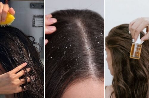 dandruff