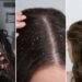 dandruff