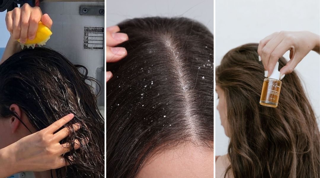 dandruff